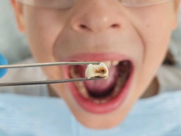 Best Emergency Dental Care for Broken or Chipped Teeth in Park City, KS